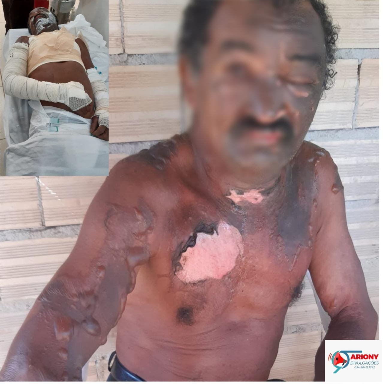 Mulher queima partes do corpo de homem com óleo quente por vingança, em Santana do Araguaia