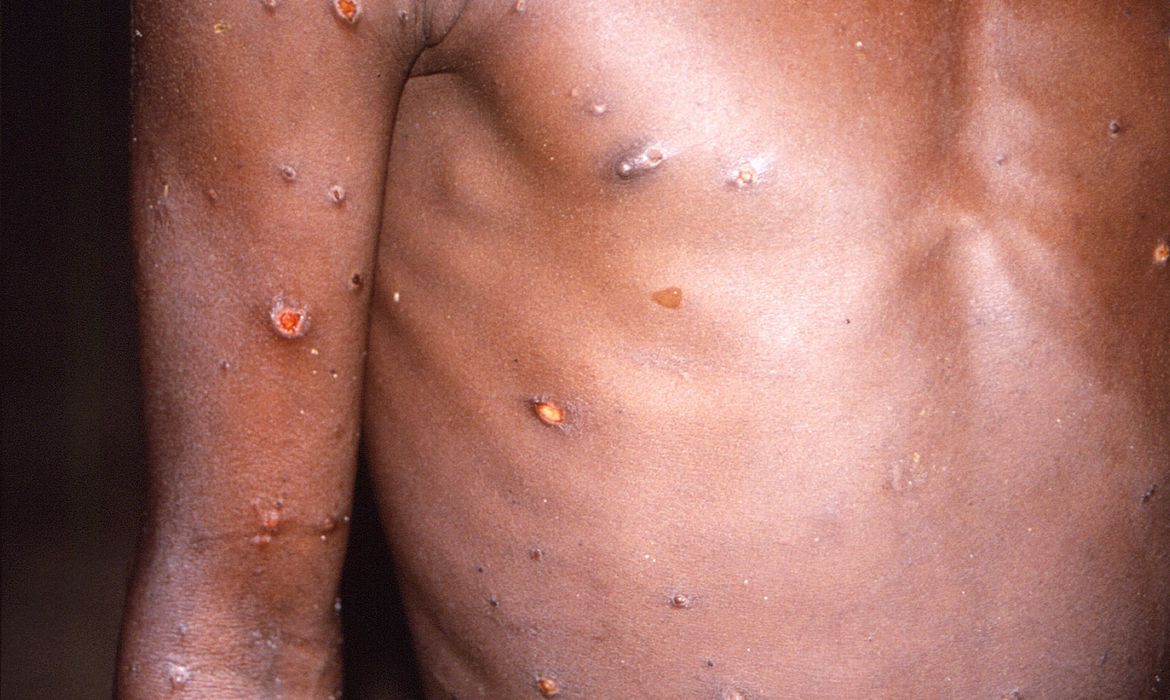 Brasil já tem 11 casos de varíola dos macacos, confirma Ministério da Saúde